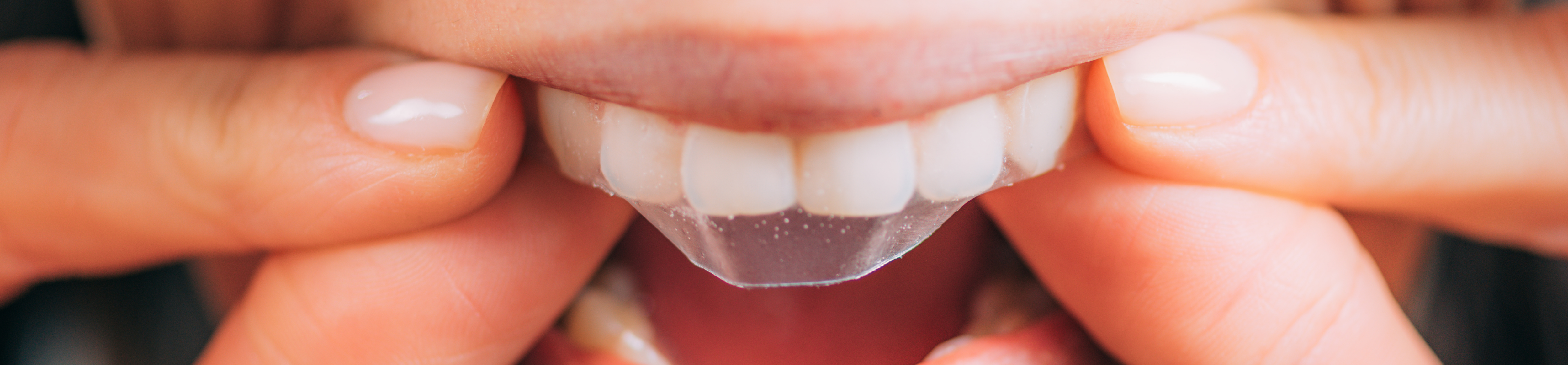 The Truth about Illegal Teeth Whitening